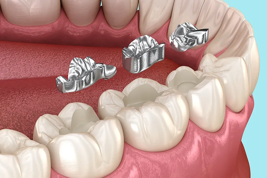 3D illustration of mercury fillings being removed from molars. Schedule Amalgam Filling Mercury Detoxication treatment from Shelley Cole, M.D. of Healthy Success in Temple, Texas.