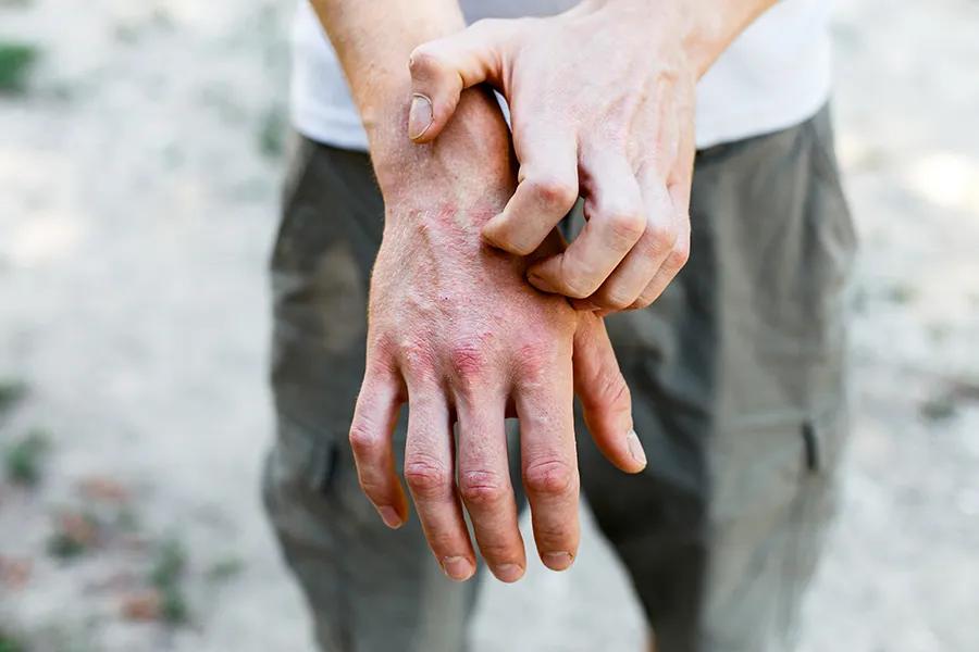 Close-up of a man scratching his hands while experiencing Psoriasis. Get care for Psoriasis from Shelley Cole, M.D. of Healthy Success in Temple, Texas.