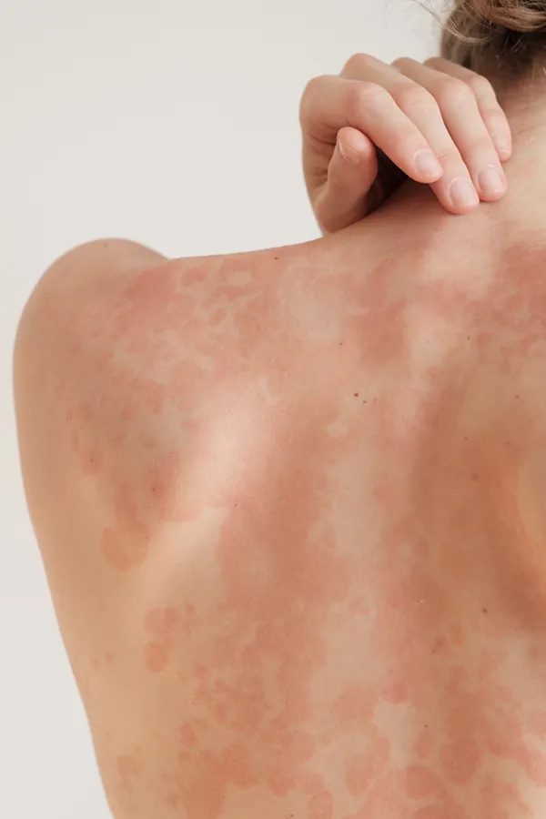 The back and shoulder of a woman experiencing Psoriasis. Get treatment for Psoriasis from Shelley Cole, M.D. of Healthy Success in Temple, Texas.