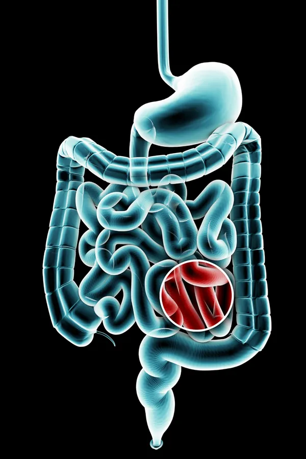3D illustration of the digestive system in blue tones, with an area of discomfort in red tones. Get treatment for Ulcerative Colitis from Shelley Cole, M.D. of Healthy Success in Temple, Texas.